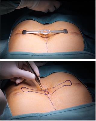 Case Report: Modified Taulinoplasty: a new technique for minimally invasive repair of pectus excavatum